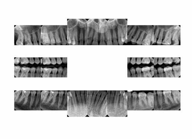 My Dental Xrays which Show Fluorosis and rampant dental decay